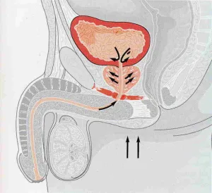 Гъбични простатит - един от най-редките видове простатит
