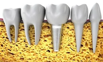 Зъбните импланти, които засягат техния живот, как да го удължат