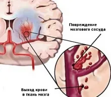 Caracteristicile Stroke - tratamentul inimii