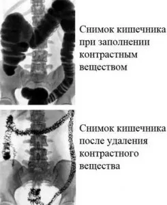 intestinale clisma cu bariu - examinarea și diagnosticul bolilor intestinului