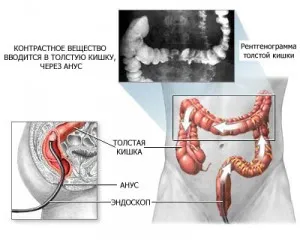 intestinale clisma cu bariu - examinarea și diagnosticul bolilor intestinului