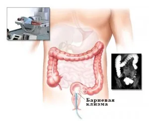 intestinale clisma cu bariu - examinarea și diagnosticul bolilor intestinului