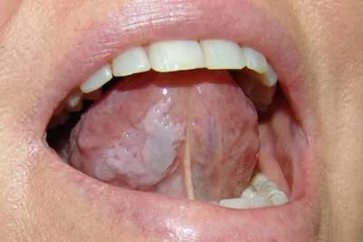 Инфекции на устата