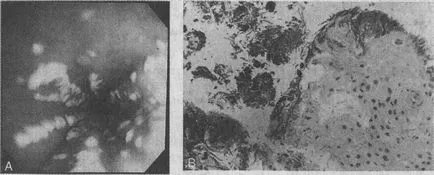 boli infectioase-inflamatorii ale esofagului