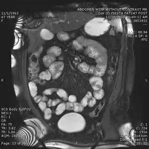 MRI изследвания на червата (хидро-MRI) в Санкт Петербург