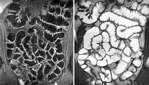 MRI изследвания на червата (хидро-MRI) в Санкт Петербург