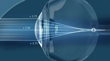 Да се ​​отървем от астигматизма от операция за очното заболяване