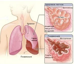 Milyen tünetei vannak a tüdőgyulladás (pneumonia)