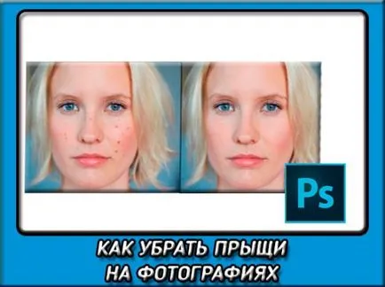 Hogyan lehet eltávolítani a pattanások fénykép segítségével Photoshop könnyedén