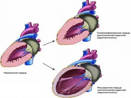 disfuncție diastolică ventriculară și miocardică tipuri, cauze, simptome, diagnostic