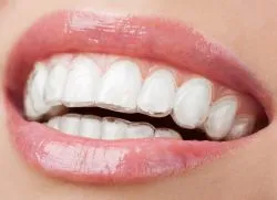 Капа за подреждане на зъбите