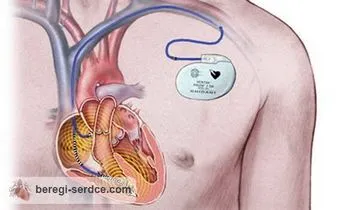 korlátozások Pacemaker - válaszokat és tanácsokat