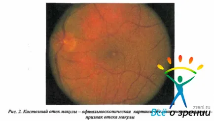 edem macular chistica