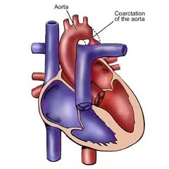 Coarcta de aorta - simptome, tratament, chirurgie