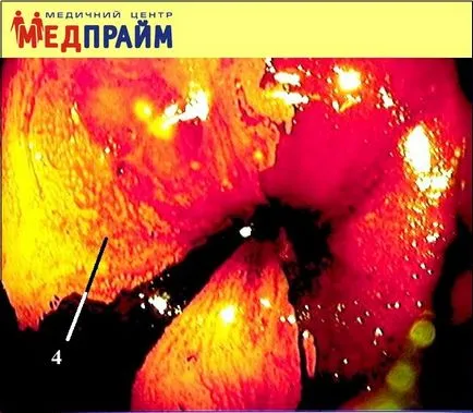 Colposcopia în diagnosticul și tratamentul bolilor de col uterin, medpraym