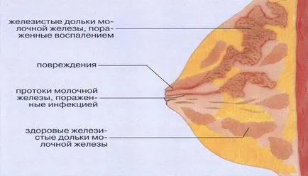 Lactostasis la mamele care alăptează este și cum să-l trateze