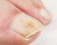 Nail psoriasis lézeres kezelés, orvosi, otthon, okoz pszoriázis, a fajok