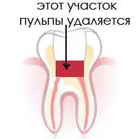 Лечение на пулпит без отстраняване на нерв