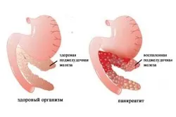 Лечение на хроничен панкреатит у дома