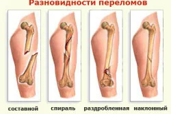 Лечение на фрактури на народни средства