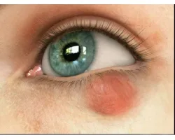 Chalazion лечение народни средства