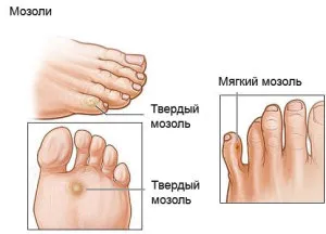 Îndepărtarea cu laser a calusuri si bataturile