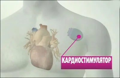 bradycardia a hipertónia kezelésére, amely gyógyszereket lehet venni