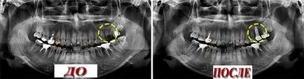 preturi implanturi dentare cu laser, comentarii