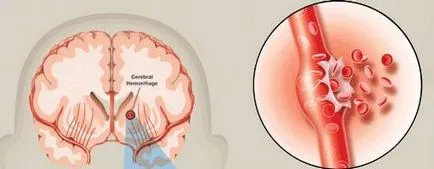 Accident vascular cerebral Tratamentul in Israel (dupa un accident vascular cerebral), preturi, israhospital