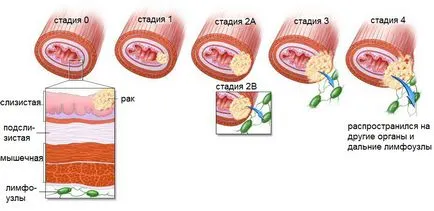 A kezelés nyelőcsőrák népi jogorvoslat gyógynövények, gombák és receptek