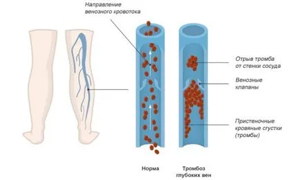 artériás trombózis kezelése - Causes, tünetek és kezelési módszerek