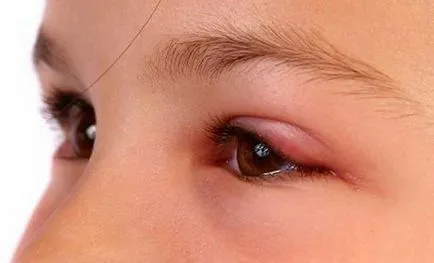 Chalazion лечение народни средства