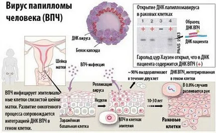 Tratamentul virusului papiloma uman, terapii eficiente, remedii populare tradiționale