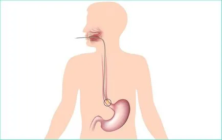 Лечение на повърхностна гастрит