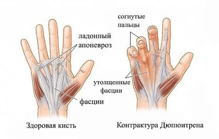 Лечение на контрактура Дюпюитрен може консервативно и хирургично