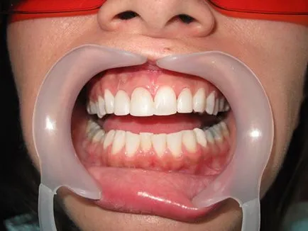 Lézer fogak implantátumok Árak, visszajelzések