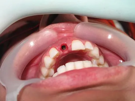 Лазерно зъби импланти цени, коментари