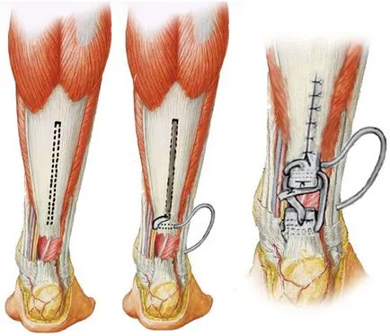 Лечение на остаряла ахилесово сухожилие разкъсване