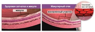 Макулата методи оток на диагностиката и лечението