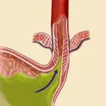 Eeróziót és fekélyes oesophagitis, nyelőcső, tünetek és kezelés