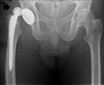 Hip arthroplasty Moszkvában