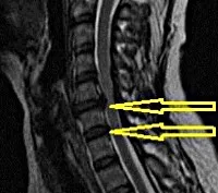 herniated discuri ale coloanei cervicale - cauze, simptome, diagnostic și tratament