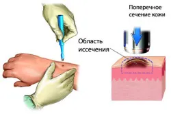 Tratamentul melanomului, prevenirea, imunoterapie