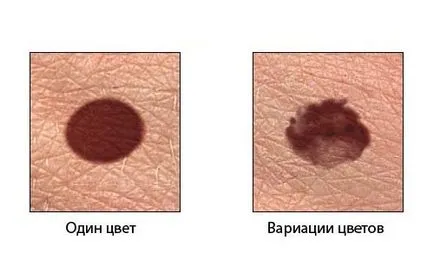 Tratamentul melanomului, prevenirea, imunoterapie