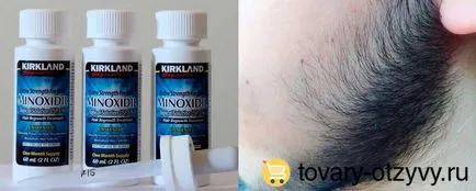 Minoxidil Hair vélemények, használati utasítás