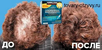 Minoxidil Hair vélemények, használati utasítás