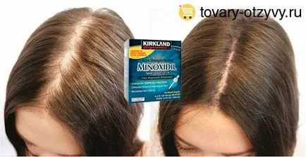 Minoxidil Hair vélemények, használati utasítás