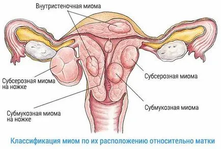 fibrom uterin tratament, simptome, cauze