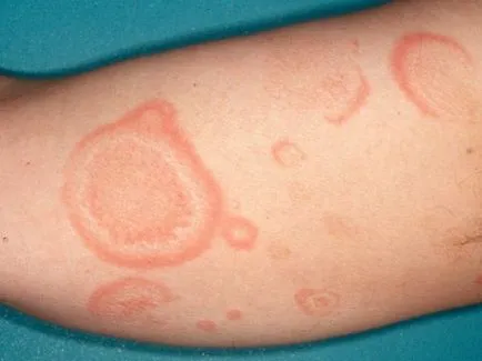 Erythema multiforme váladékos polimorf hólyagos multiforme