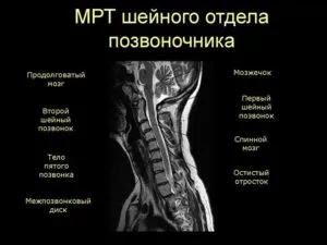 MRI на шийните прешлени, който показва обучение